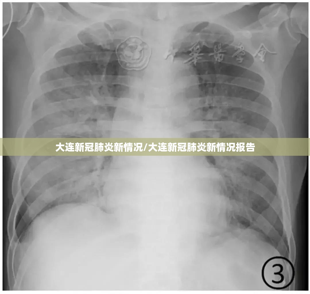 大连新冠肺炎新情况/大连新冠肺炎新情况报告 大连新冠肺炎新情况/大连新冠肺炎新情况报告