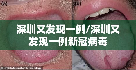 深圳又发现一例/深圳又发现一例新冠病毒 深圳又发现一例/深圳又发现一例新冠病毒