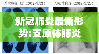 新冠肺炎最新形势:支原体肺炎有什么症状 新冠肺炎最新形势:支原体肺炎有什么症状